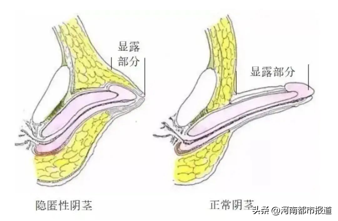 鸡鸡(“鸡鸡”太迷你，长不大，怎么回事？)