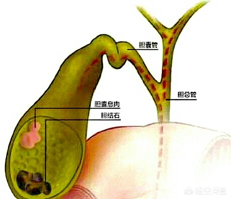 胆囊息肉会消失吗？