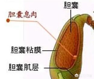 胆囊息肉会消失吗？