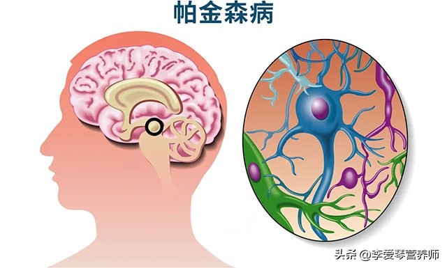 老年人的帕金森致死率有多高？