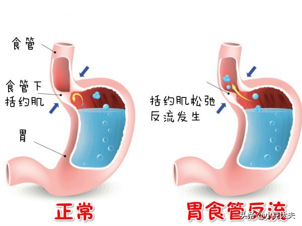 胃酸过多，吃点什么食物或者零食可以减少胃酸？